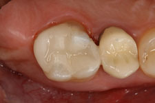 Tooth Colored Filling 01 - After