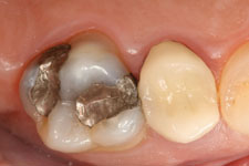 Tooth Colored Filling 01 - Before